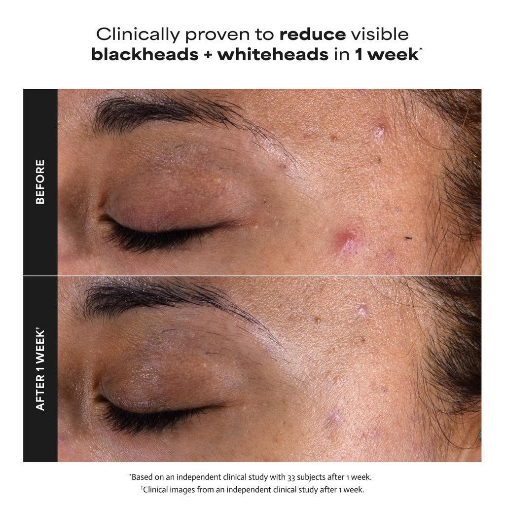 Paula's Choice SKIN PERFECTING 2% BHA Liquid Exfoliant with Salicylic Acid, Facial Polish for Enlarged Pores, Wrinkles & Fine Lines, Suitable for Blackhead-Prone Skin, Fragrance-Free
