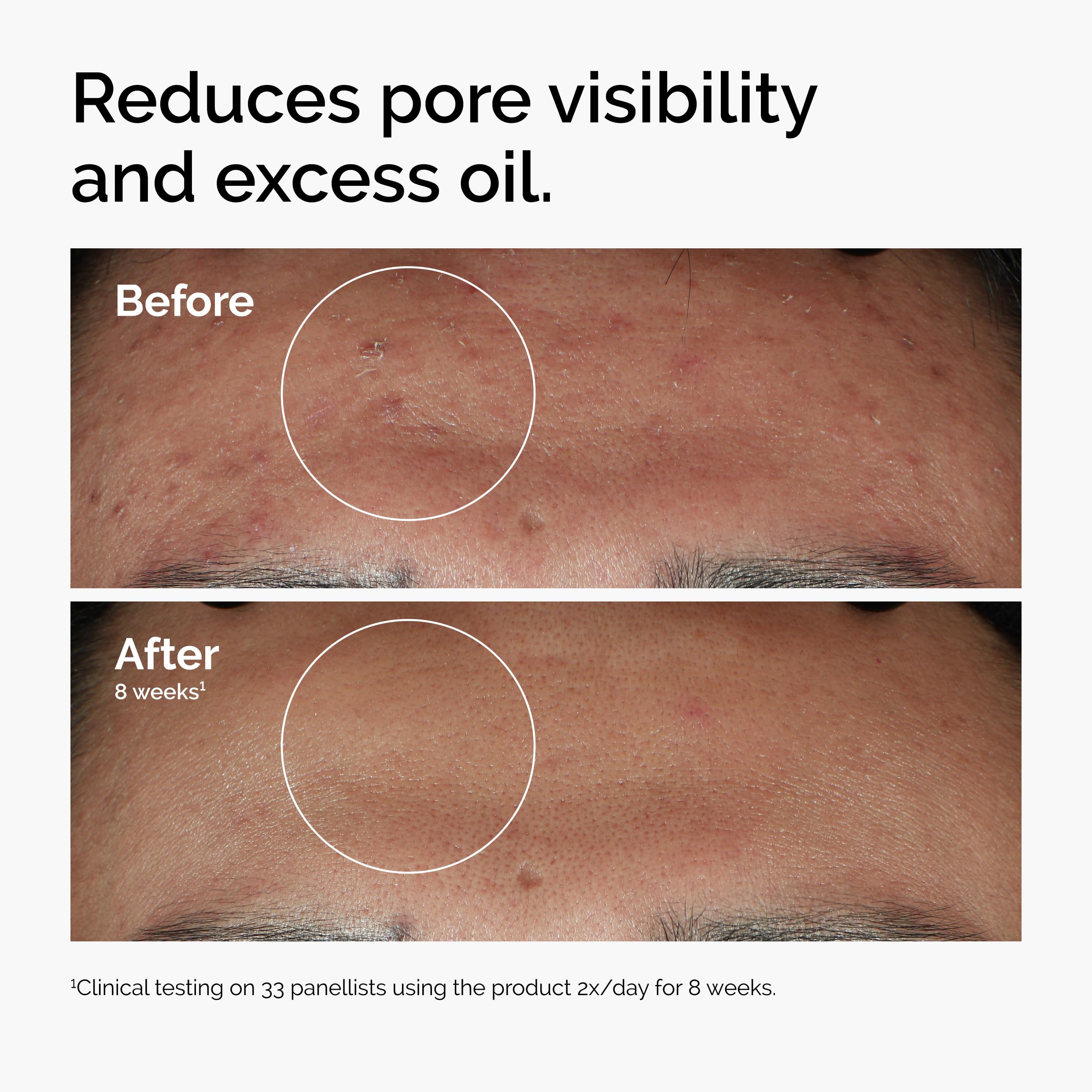 The Ordinary Niacinamide 10% + Zinc 1%, Smoothing Serum for Blemish-Prone Skin
